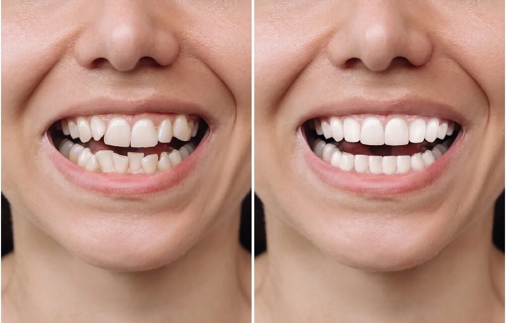 Facettes dentaires : Une opération simple pour restaurer un sourire