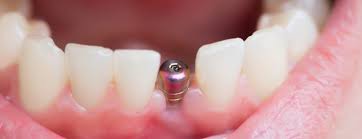 Quels types d’implants dentaires existe-t-il ?