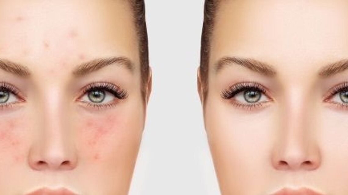 Qu’est-ce que l’acné ? comment la traiter ?