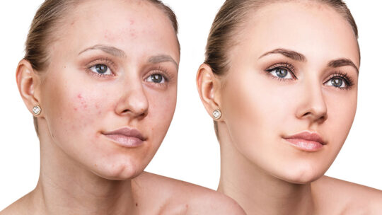 Comment raffermir la peau du visage