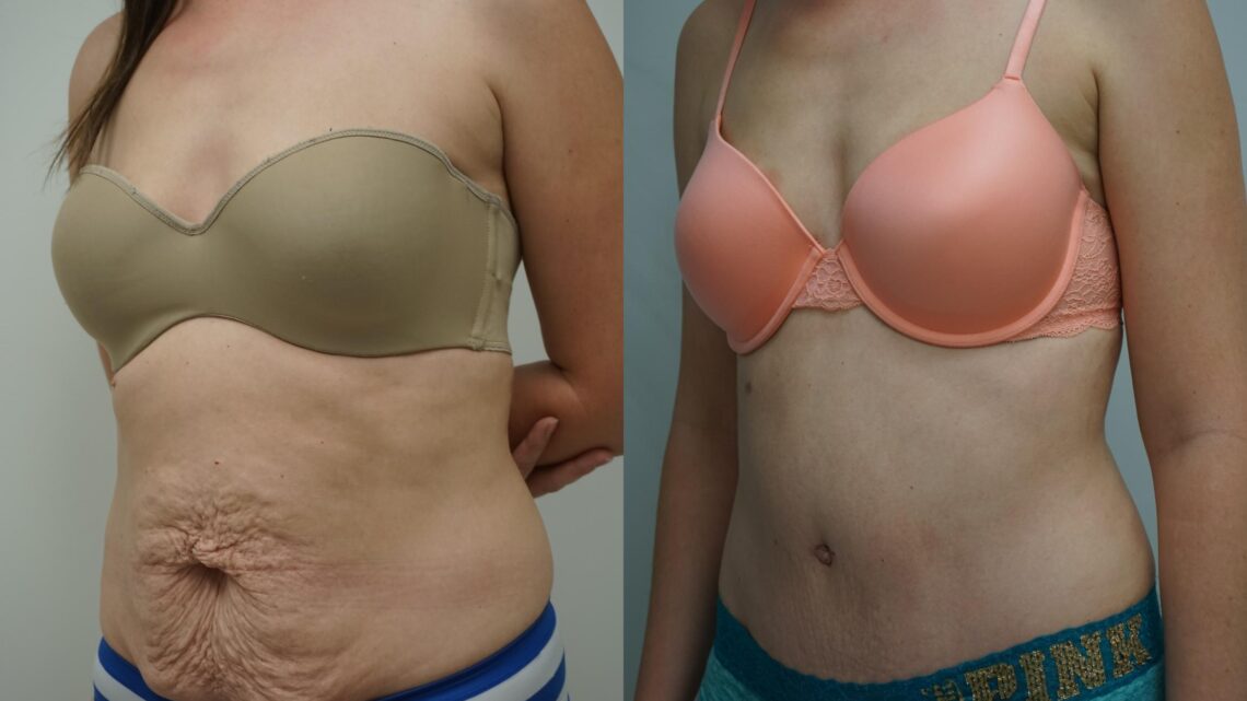 Abdominoplastie circulaire Tunisie : Guide complet et tarifs