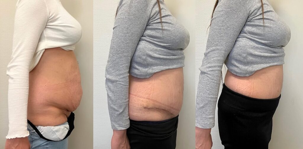 résultats abdominoplastie Tunisie