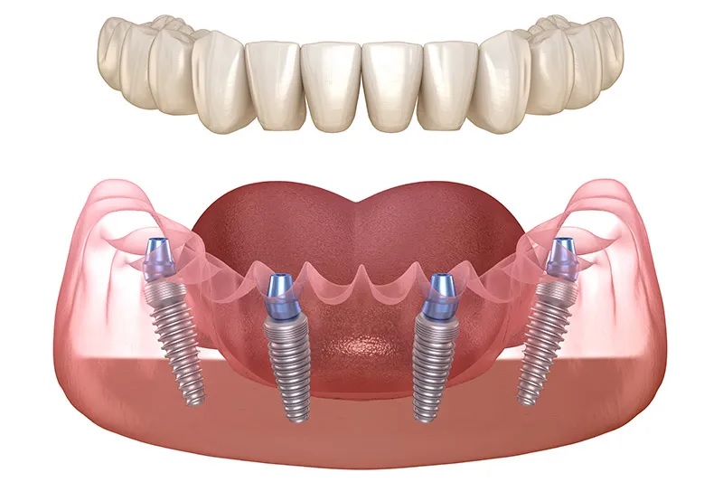 all on 4 implant dentaire