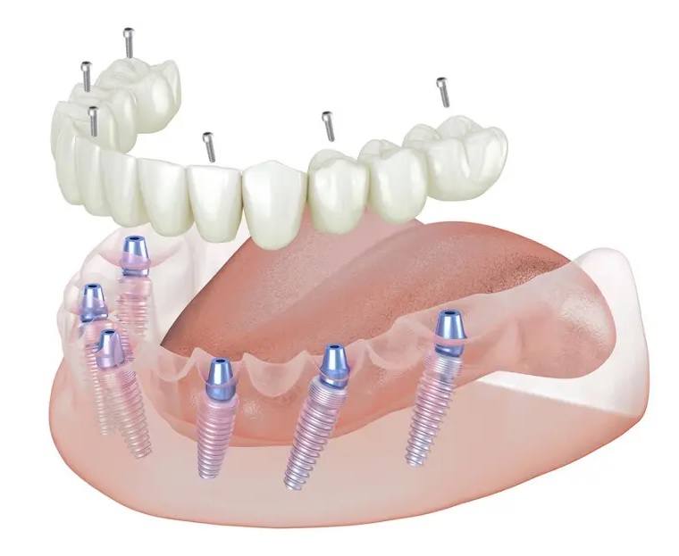 Prix implant dentaire All on 6 : Guide complet et tarifs