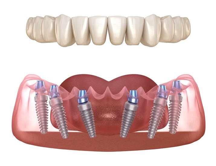 All on 6 prix implant