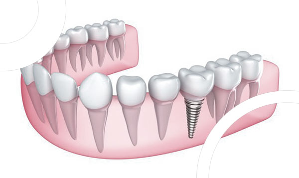 implants dentaires Tunisie