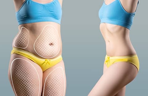 Liposuccion complète Full HD : Solution idéale pour les patients étrangers