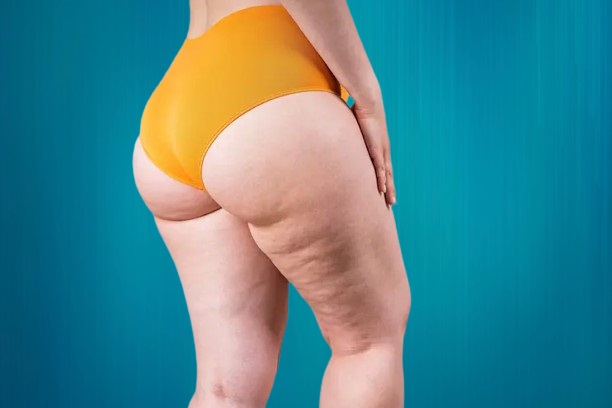 Chirurgie esthétique cuisses et fesses : guide complet et tarifs