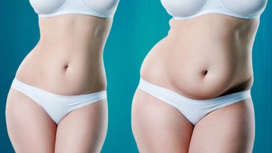 Découvrez les nouvelles techniques de liposuccion pour une silhouette affinée