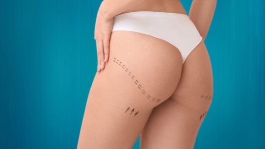 L’augmentation des fesses par prothèses : Une solution pour des formes plus généreuses