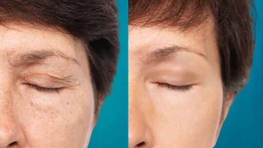 La blépharoplastie : guide complet et tarifs chirurgie des paupières